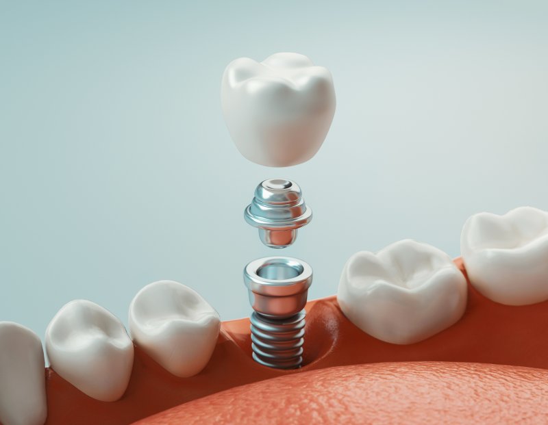 a single dental implant